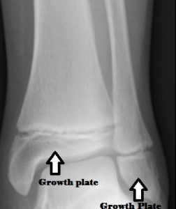 Growth Plate Closure Chart